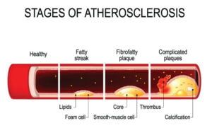 stages of atherosclerosis hardening of arteries